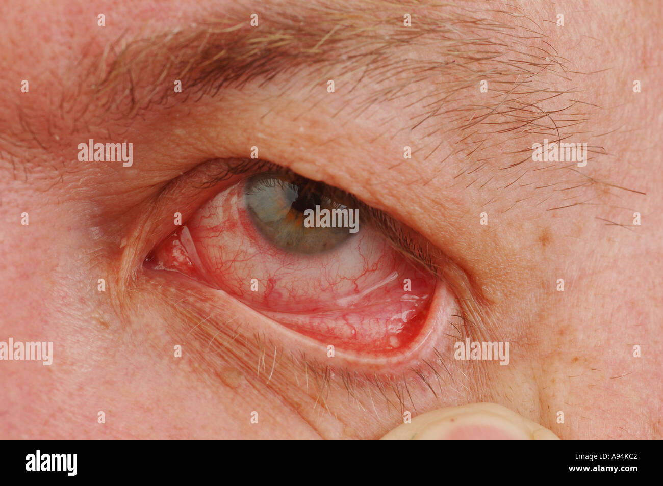My bloodshot eyes after leaving contact lenses in for to long dsca 3273 Stock Photo