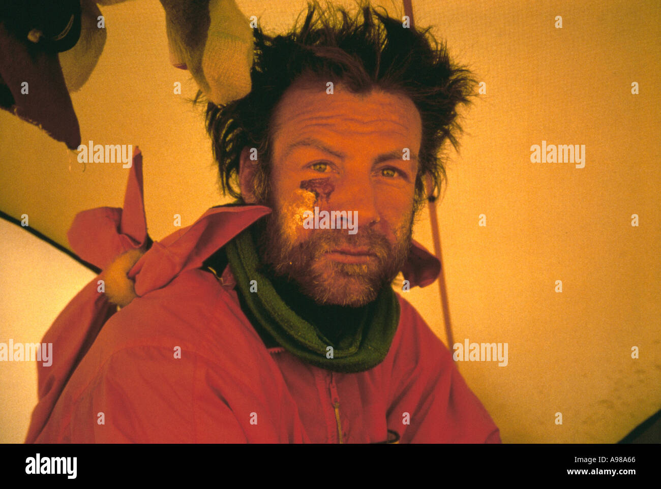 Ranulph Fiennes in a tent with severe swollen face and eyes on the Antarctic Unsupported 1992 93 bid Stock Photo