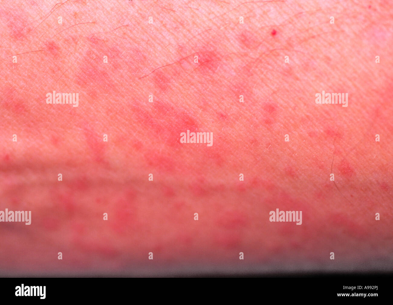 rash on a arm caused by allergy or disease Stock Photo