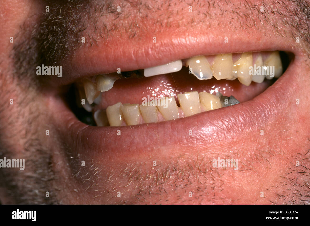 CLOSE UP OF MOUTH OF MAN WITH BAD TEETH Stock Photo