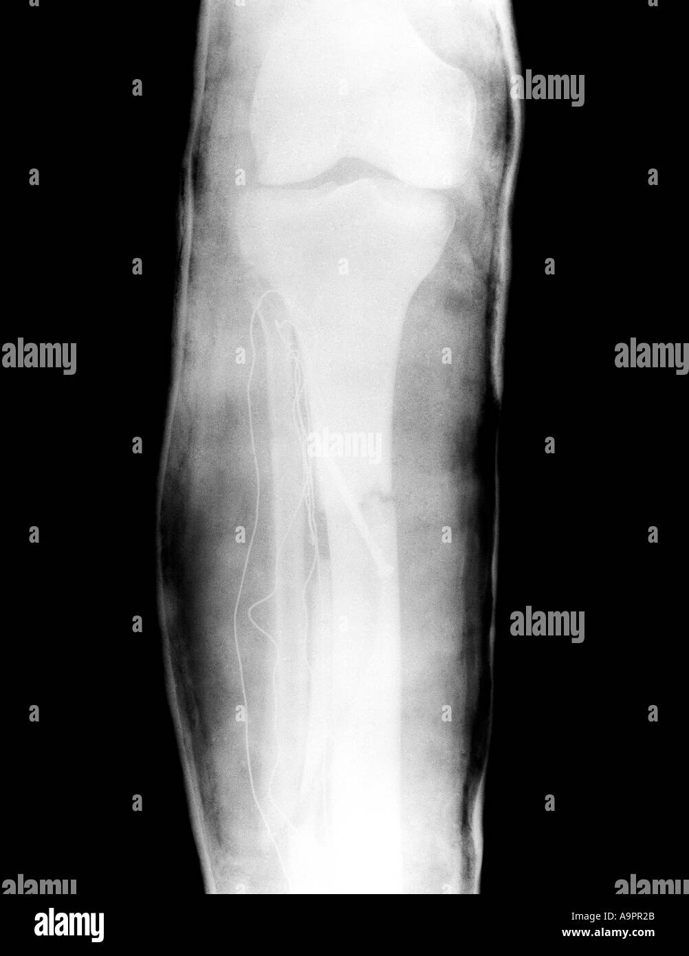 Compound Fracture X Ray