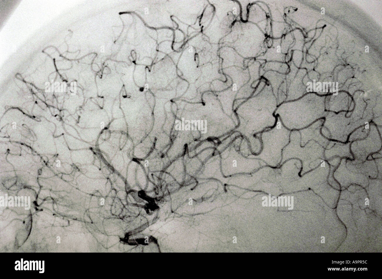 Angiogram anterior cerebral artery embolism Stock Photo