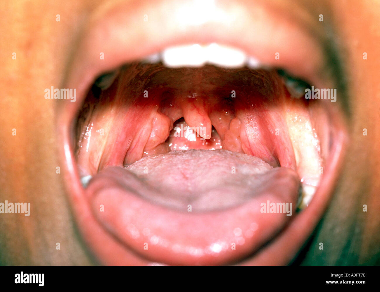 Normal Vs Swollen Tonsil