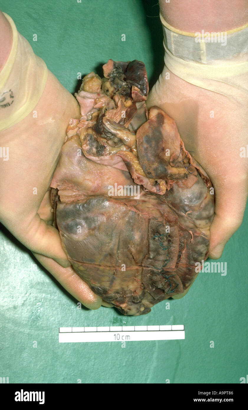 Heart specimen myocardial infarction Stock Photo