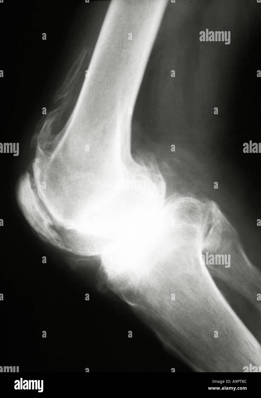 X ray osteoarthritis of the knee Stock Photo - Alamy