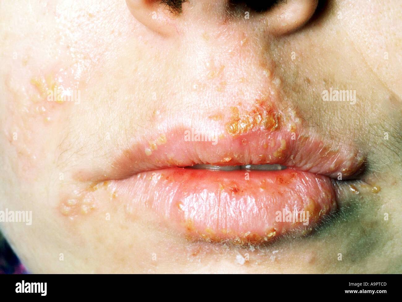 Herpes simplex cold sores on lips and face Stock Photo - Alamy