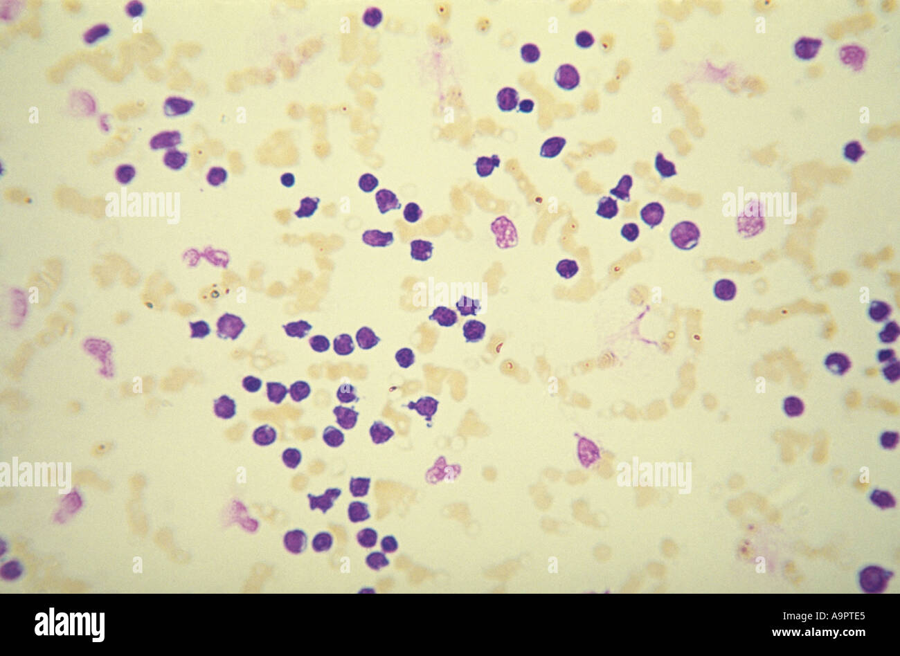 Photomicrograph acute myeloid leukemia Stock Photo
