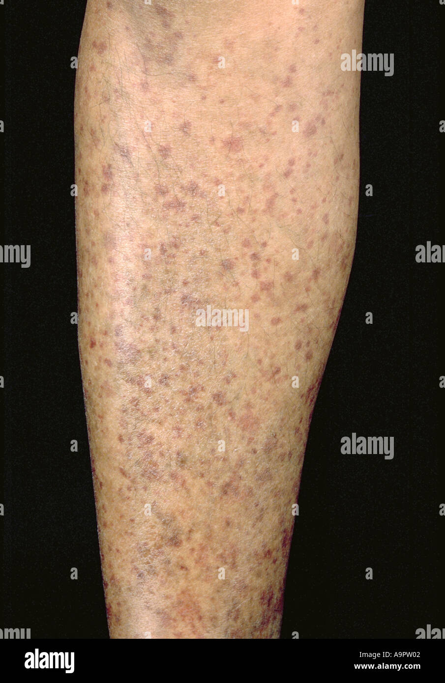Vasculitic rash Stock Photo