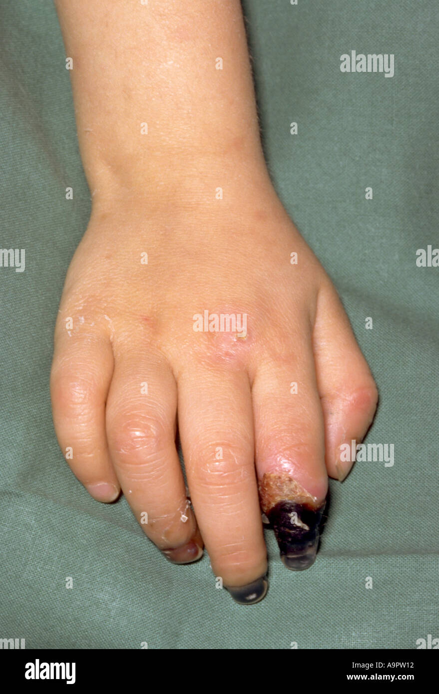 Meningococcal disease gangrene Stock Photo