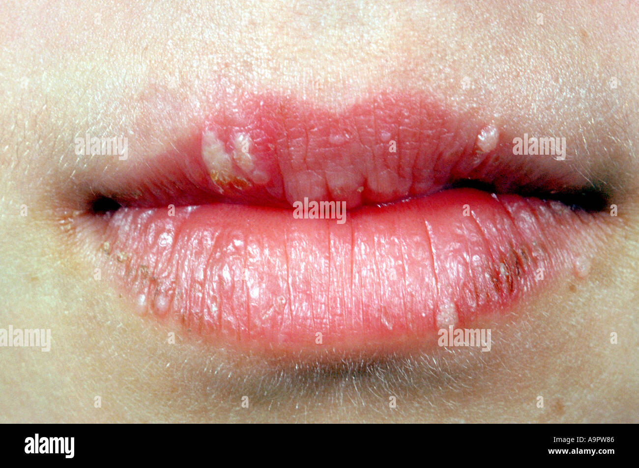 Herpes simplex cold sores on lips Stock Photo