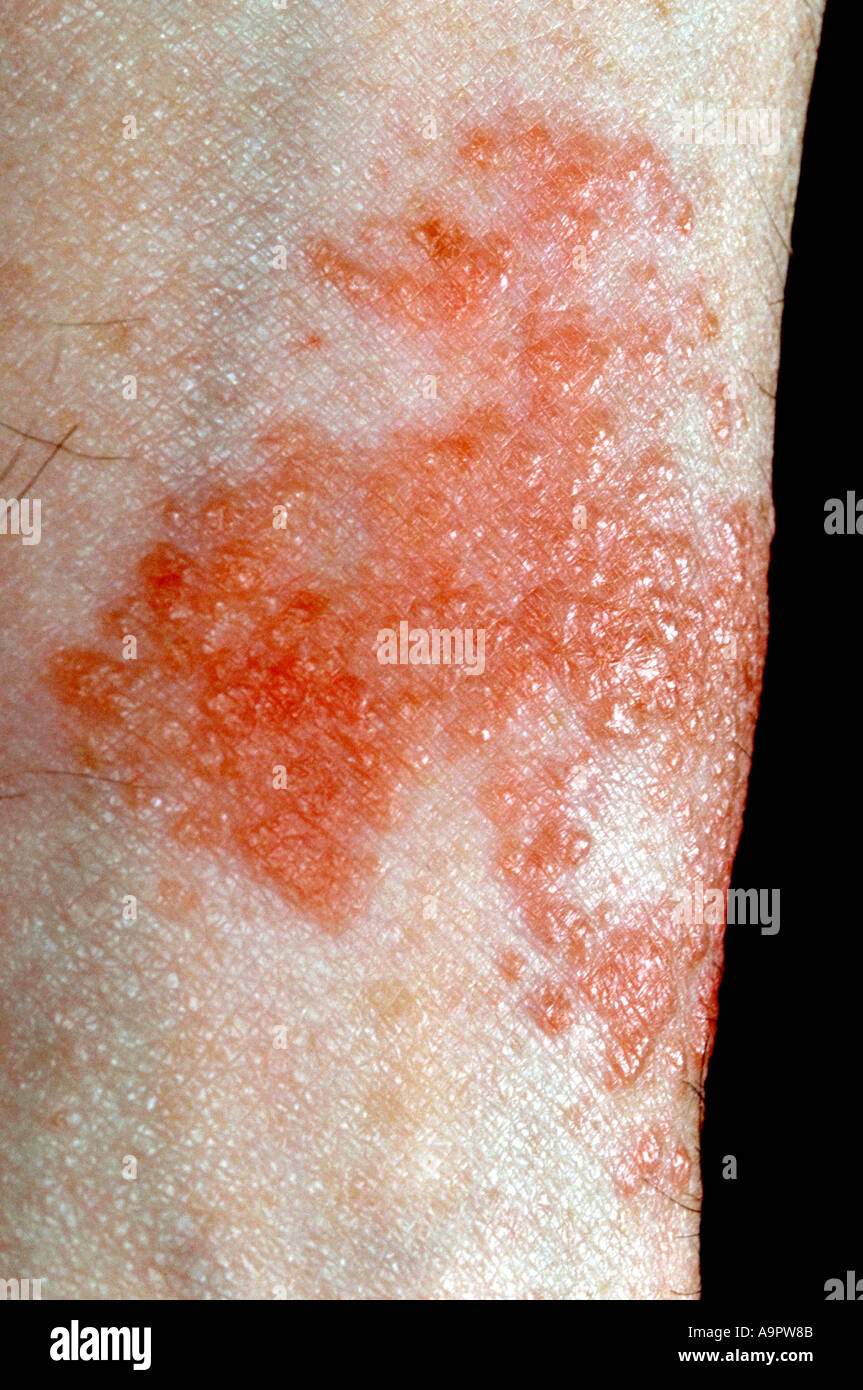 Contact dermatitis Stock Photo