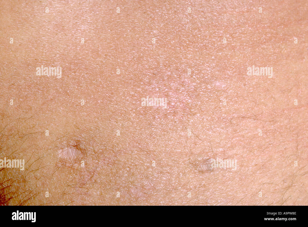 Mycosis fungoides hi-res stock photography and images - Alamy
