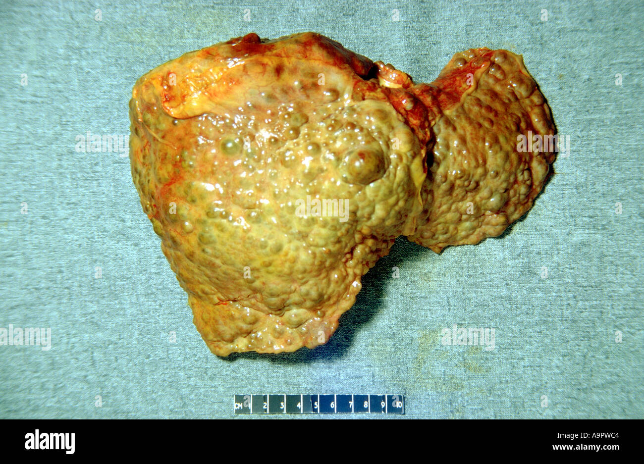 Liver specimen cirrhosis Stock Photo