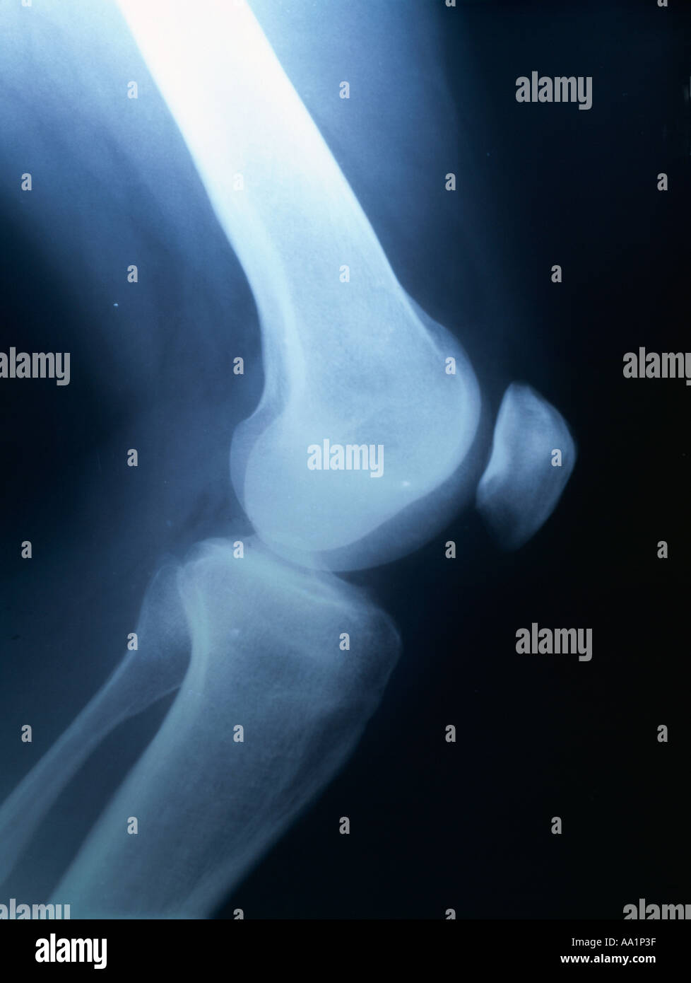 xray of  a male limb showing knee joint, knee cap, and lower part of the legtibia, and fibula, Stock Photo
