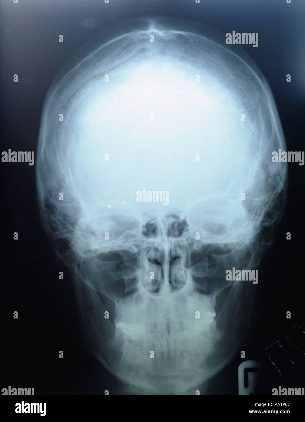 medical xray of the human skull Stock Photo Alamy