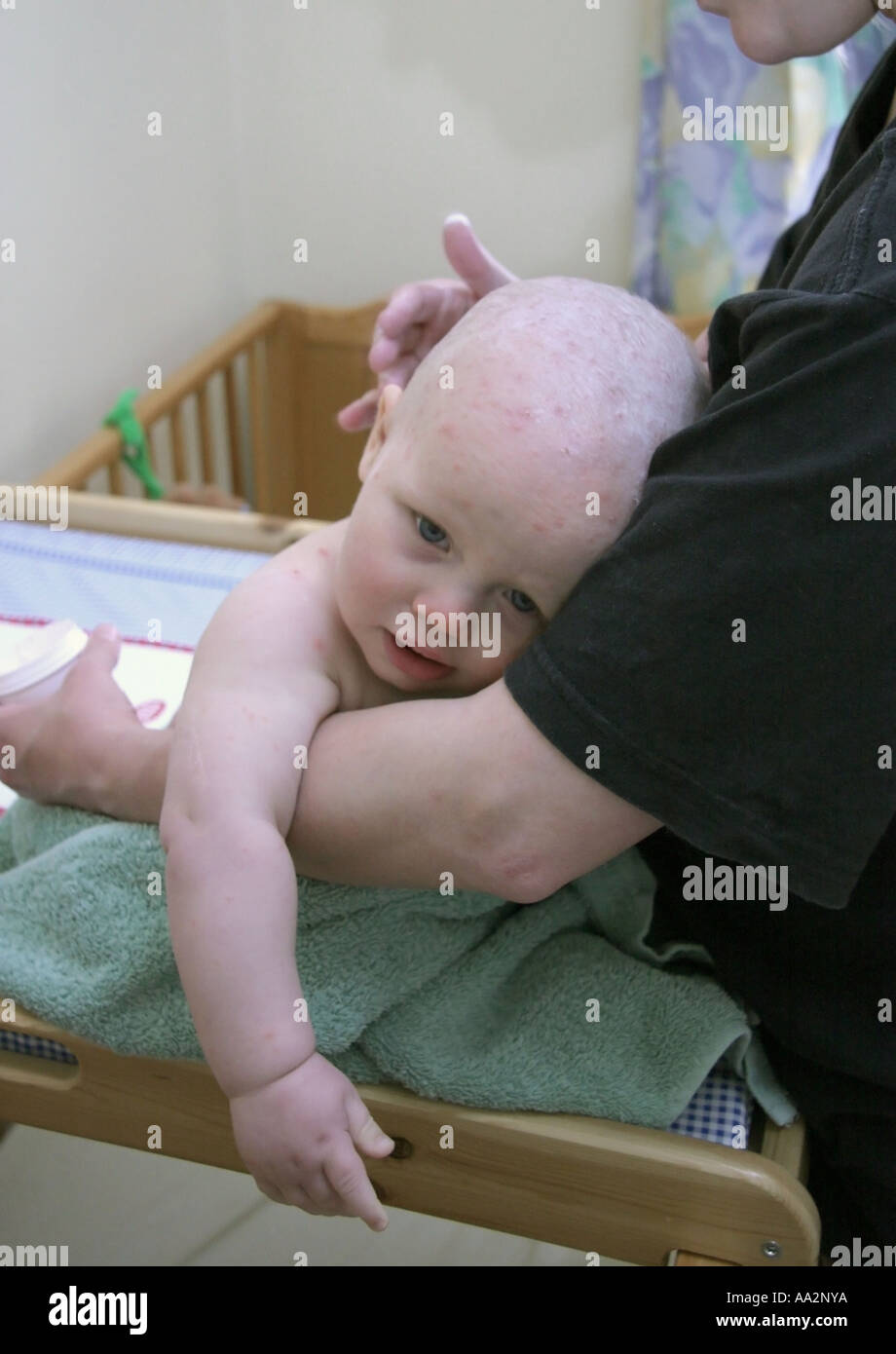 applying lotion to baby ill with chicken pox Stock Photo