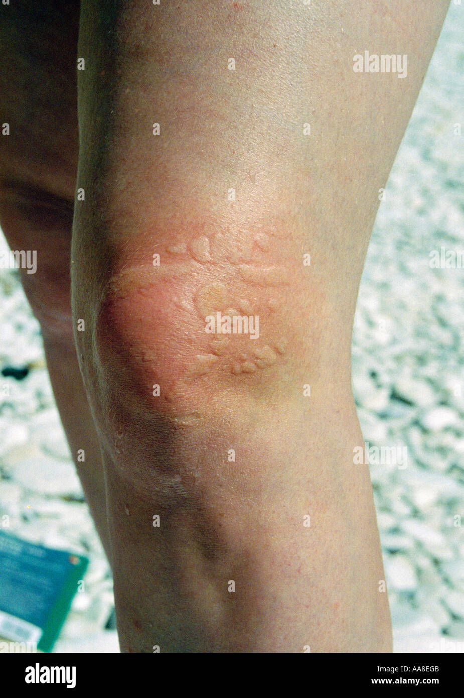 Jellyfish sting hires stock photography and images Alamy