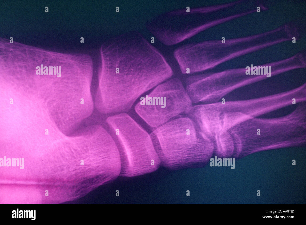 Right foot x ray hires stock photography and images Alamy