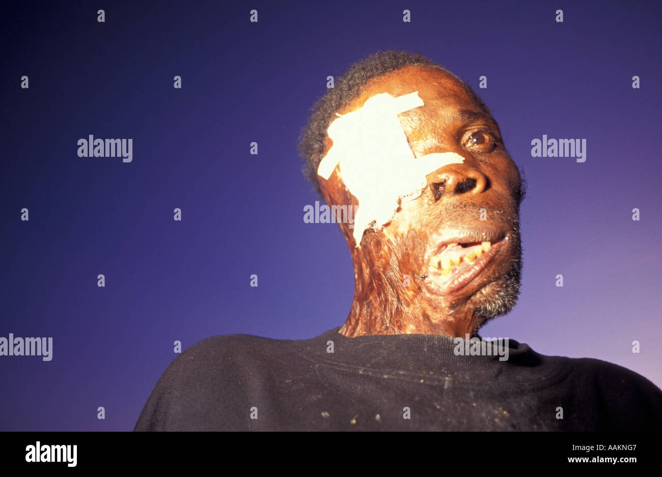 Victim of mine during war between UNITA and Angola military forces, Kuito city, Bié province, Angola, Africa, 1996. Stock Photo
