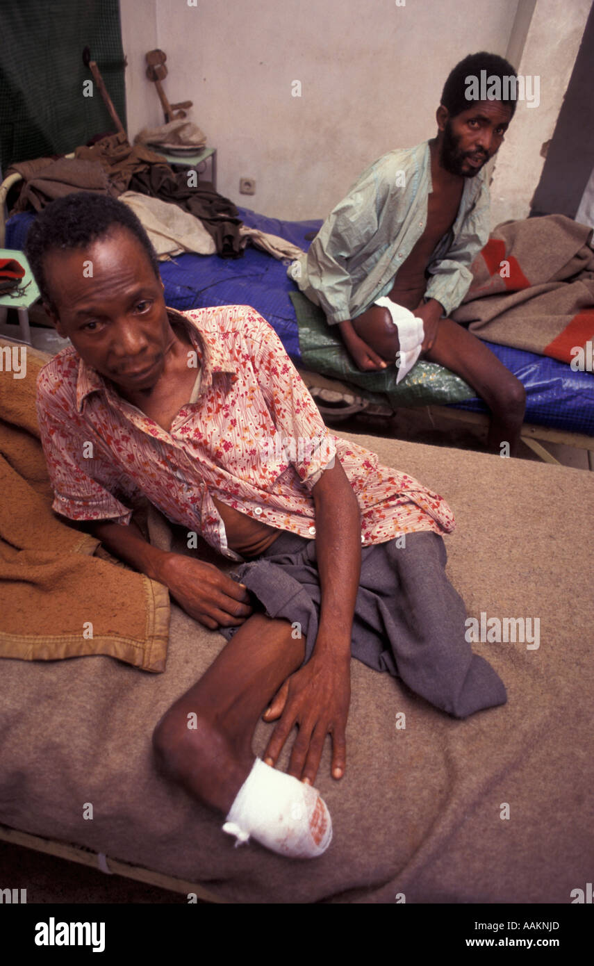 Victims of mine during war between UNITA and Angola military forces, Kuito hospital, Bié province, Angola, Africa, 1996. Stock Photo