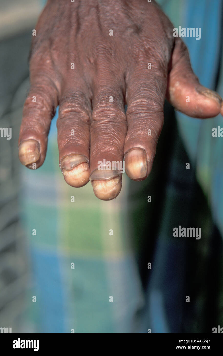 15 Fingernail and Toenail Abnormalities