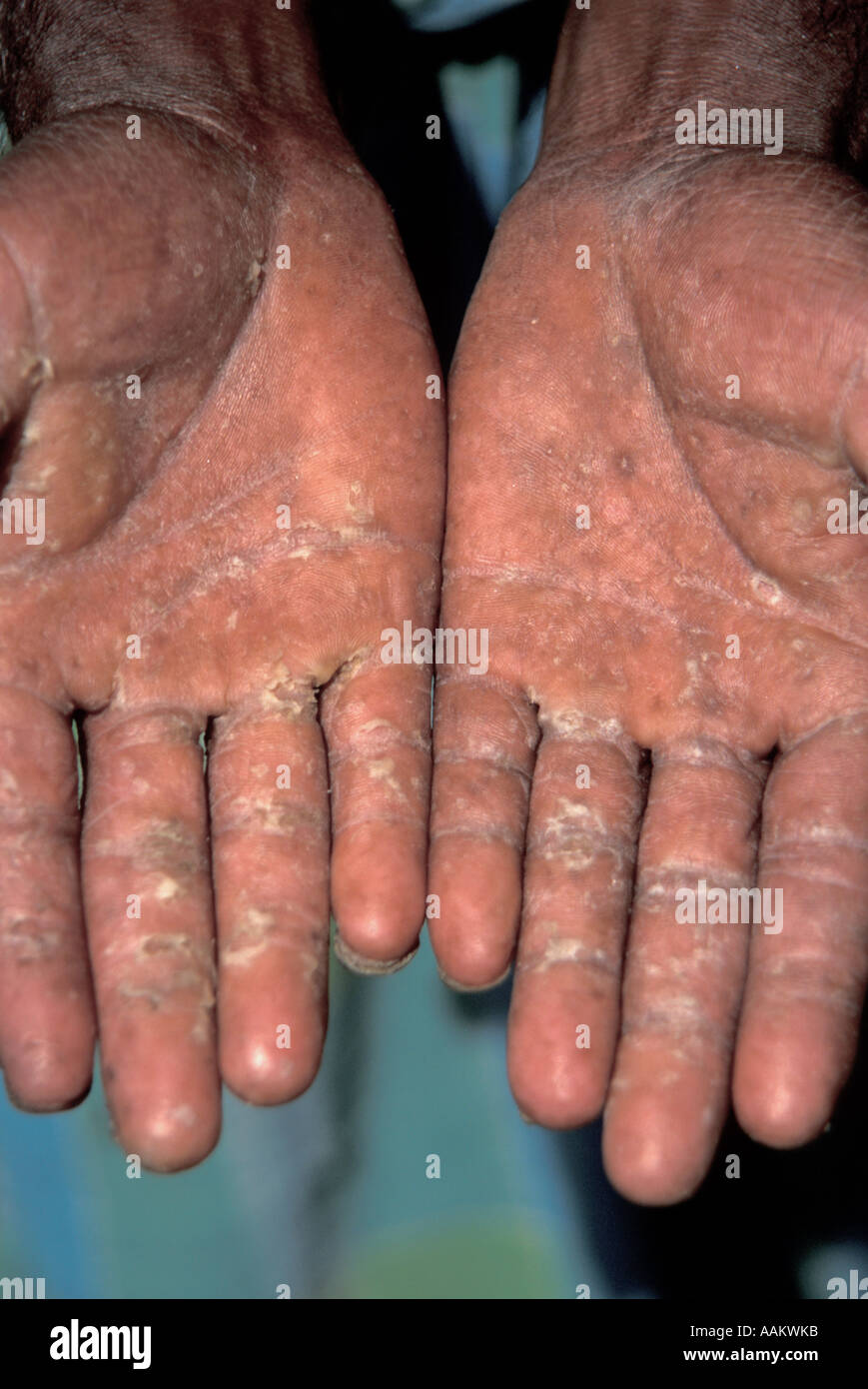 BE CAREFUL ABOUT THESE NAILS- Mees Lines - YouTube