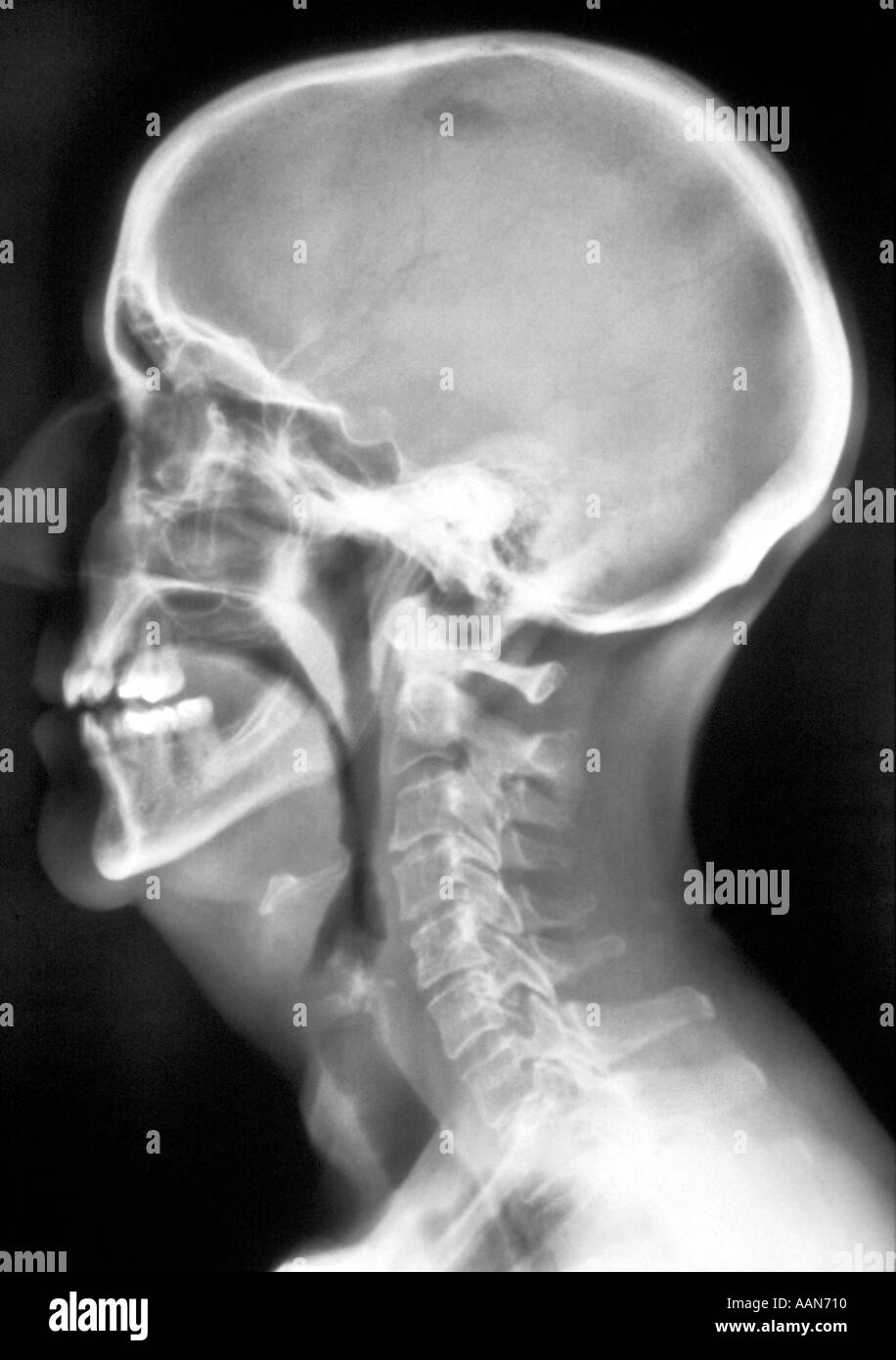 X Ray of Human Skull Stock Photo