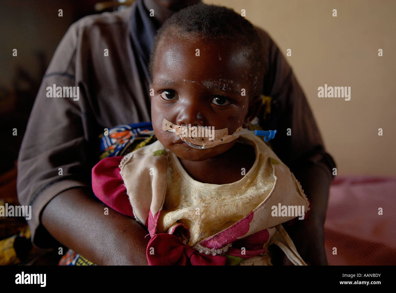 A malnourished child with feeding tube in his mouth at a CARITAS supported nutrition centre in North Kivu province in DR Congo Africa Stock Photo