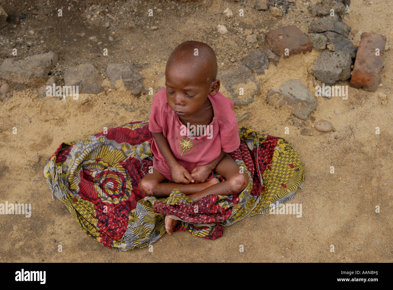A malnourished child in North Kivu province in eastern Democratic Republic of Congo Africa Stock Photo