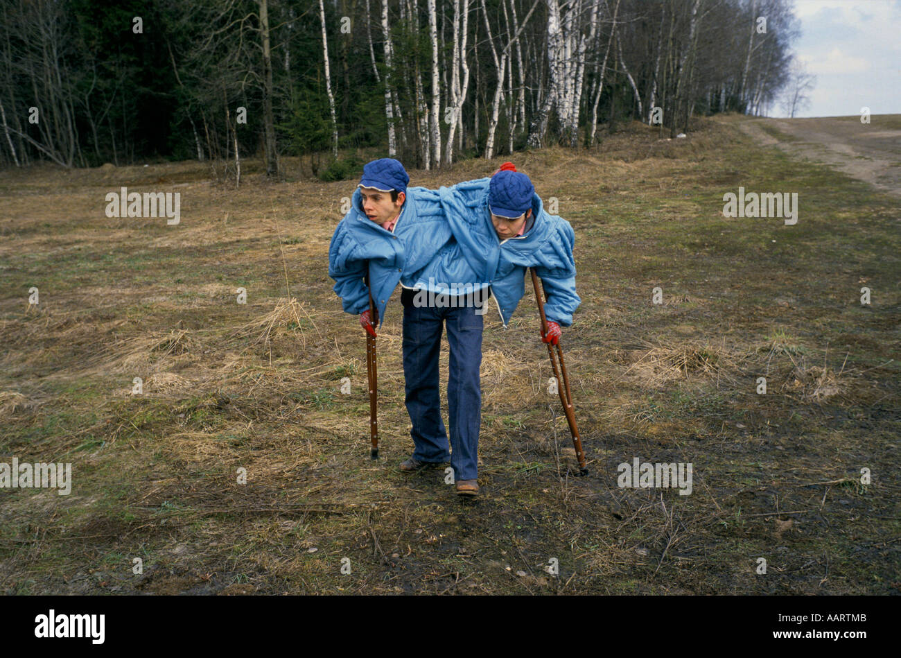 Russian conjoined twins Masha and Dasha Krivoshlyapova in Moscow Stock Photo
