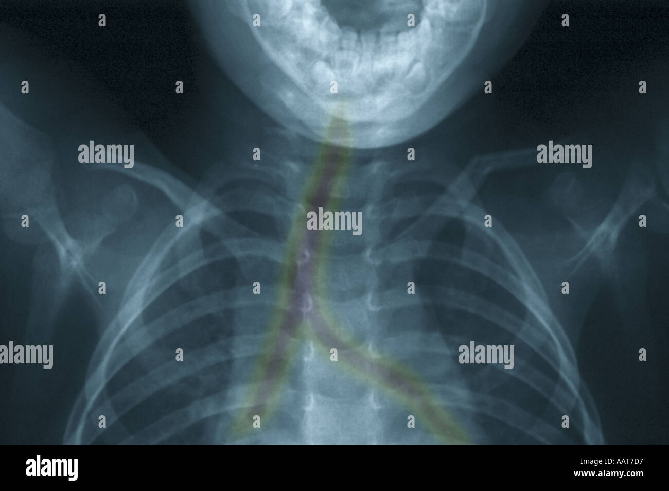 colorized xray showing fractured collarbone Stock Photo