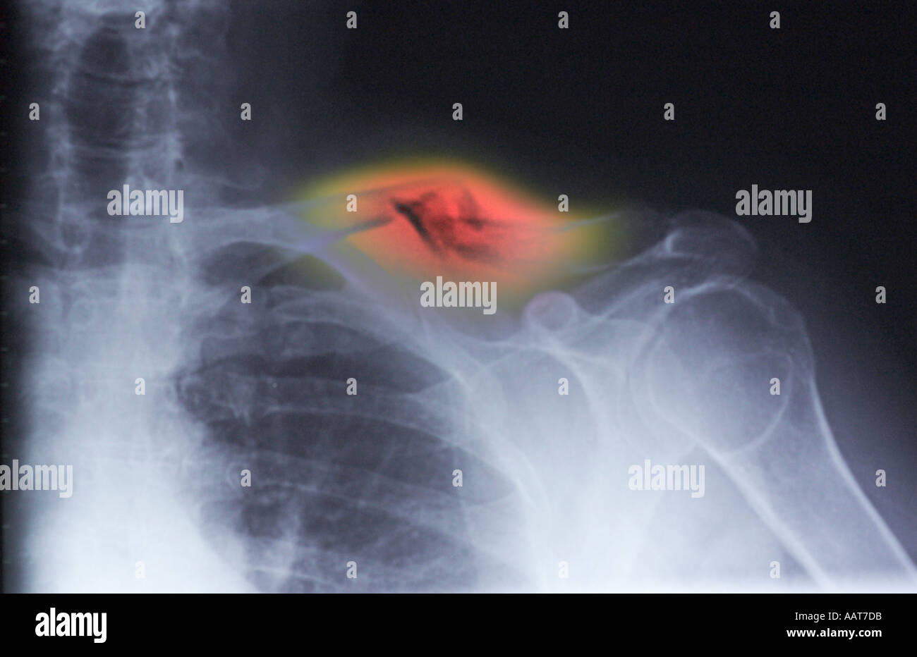 comminuted fracture of the collar bone in midshaft Stock Photo Alamy