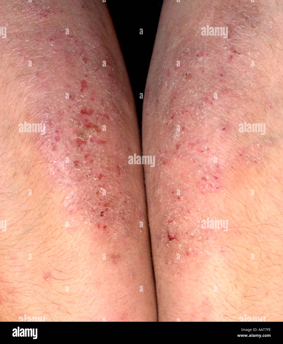 Skin rash of eczema on the forearms extensor surface of a 35 year old woman Stock Photo