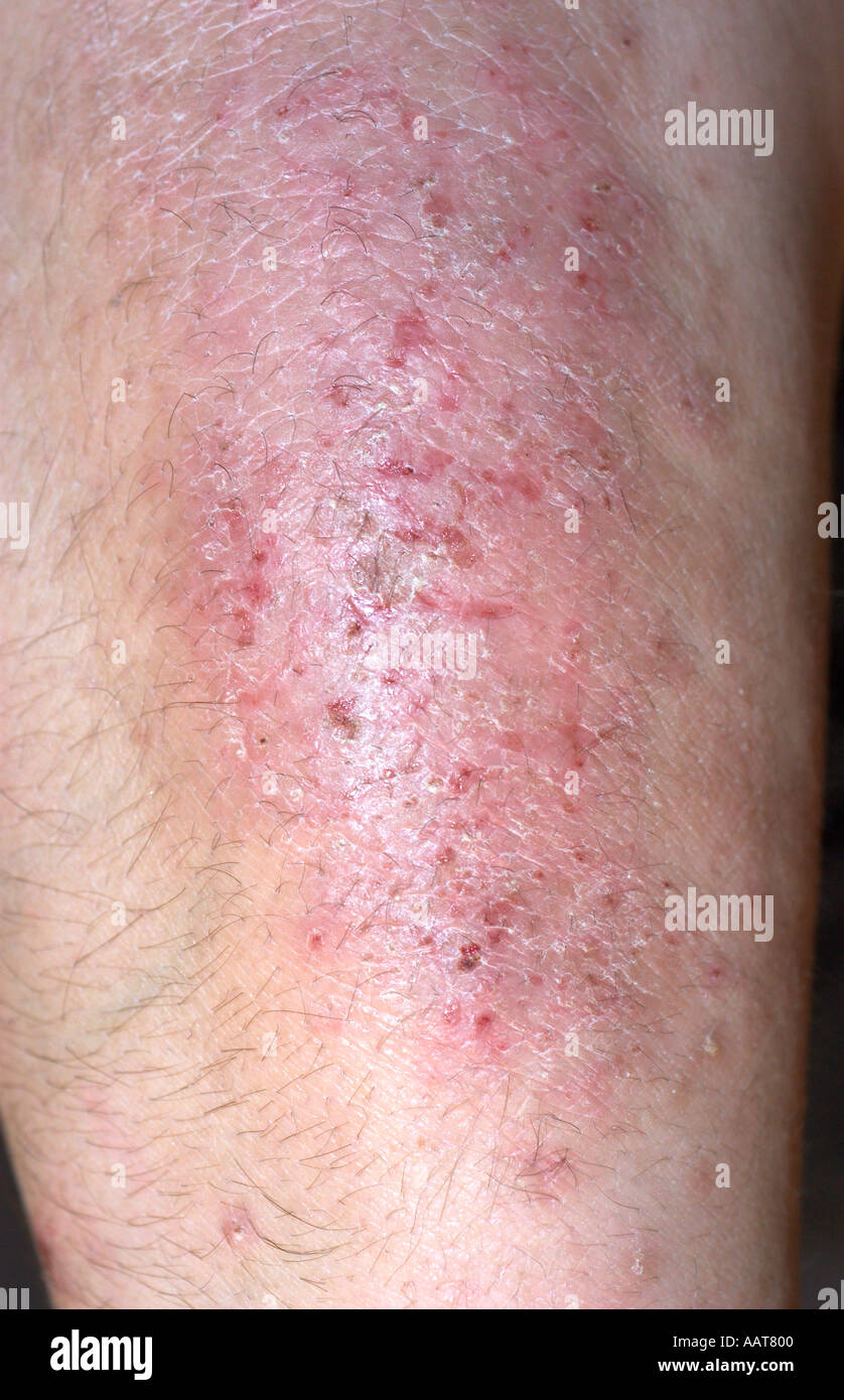 Skin rash of eczema on the forearms extensor surface of a 35 year old woman Stock Photo