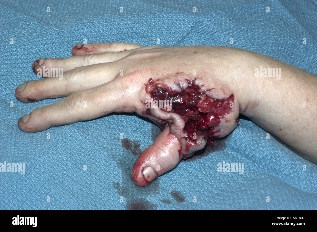 gunshot wound to hand with partial amputation of thumb Stock Photo