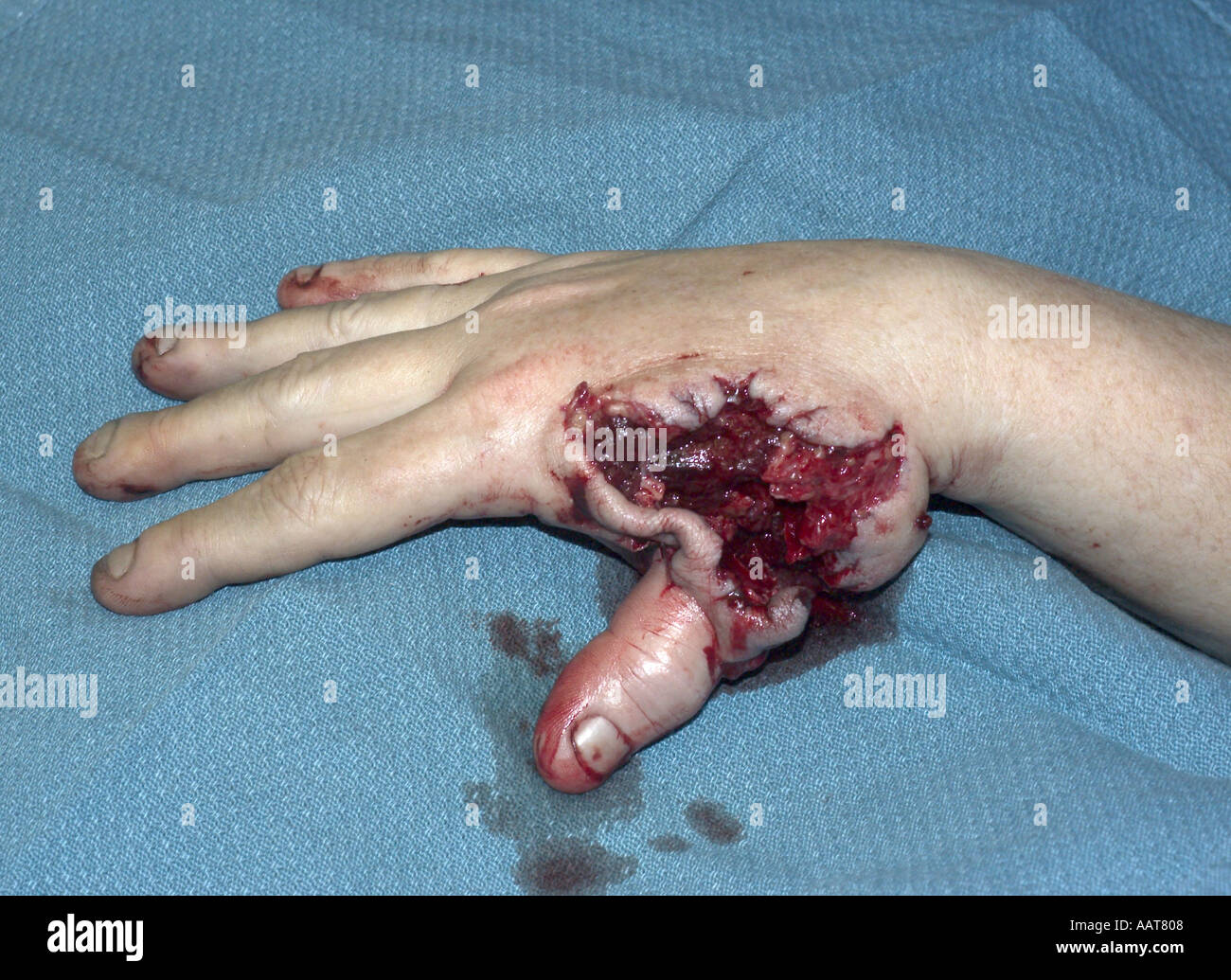 gunshot wound to hand with partial amputation of thumb Stock Photo