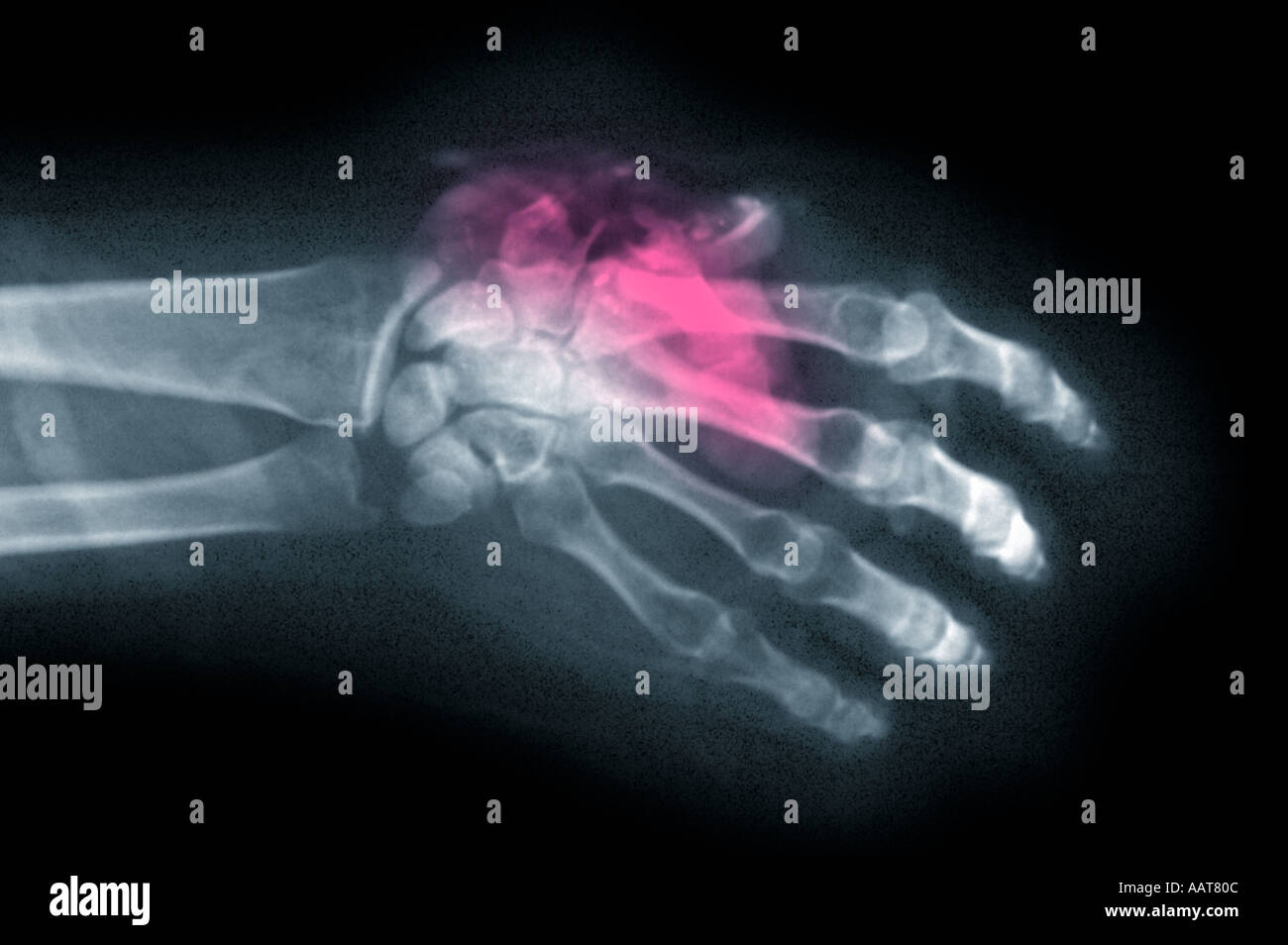 xray of gunshot wound to hand with partial amputation of thumb Stock Photo