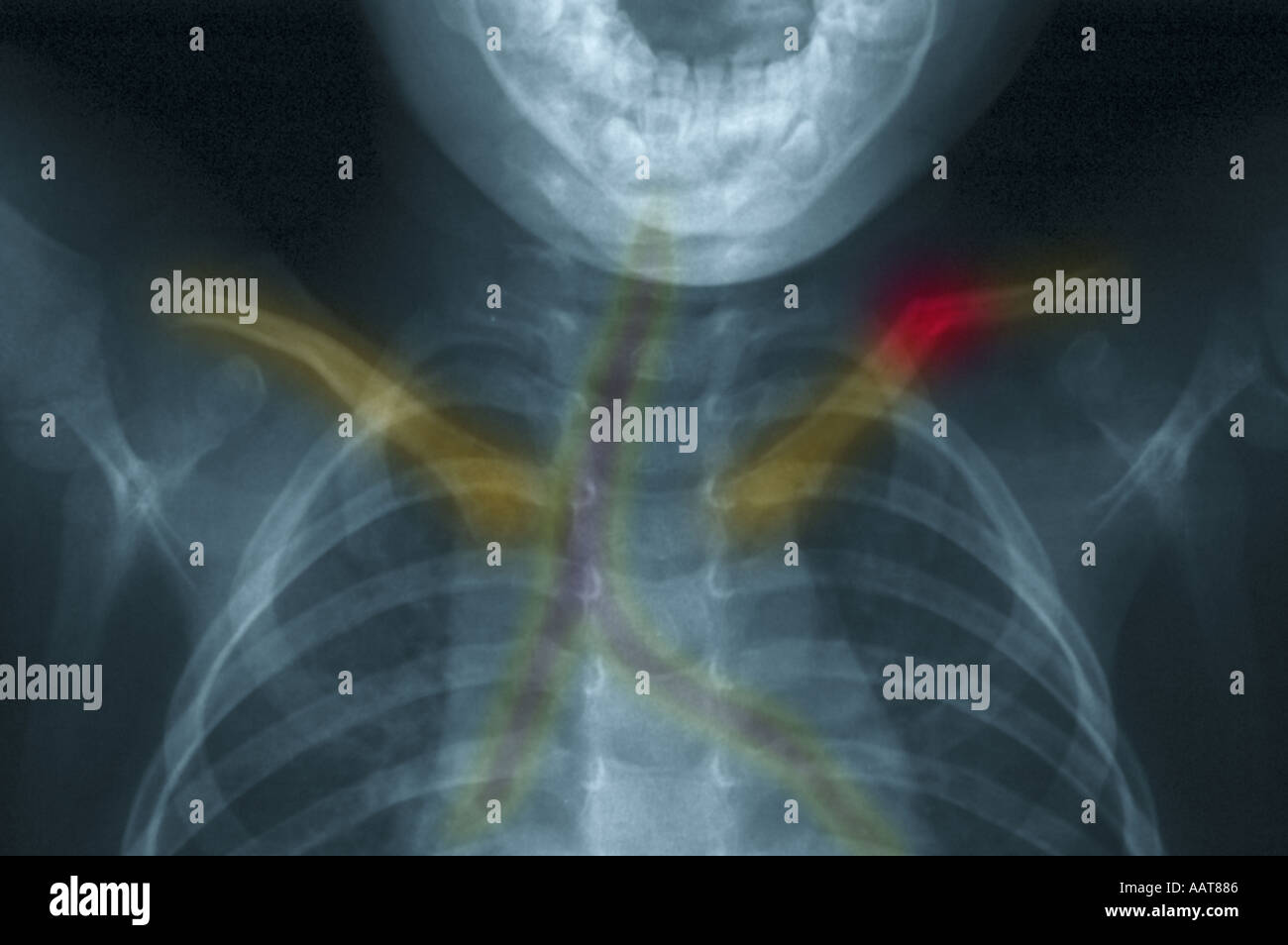 upper body chest xray of a 3 year old boy showing a fractured collarbone highlighted in red Stock Photo