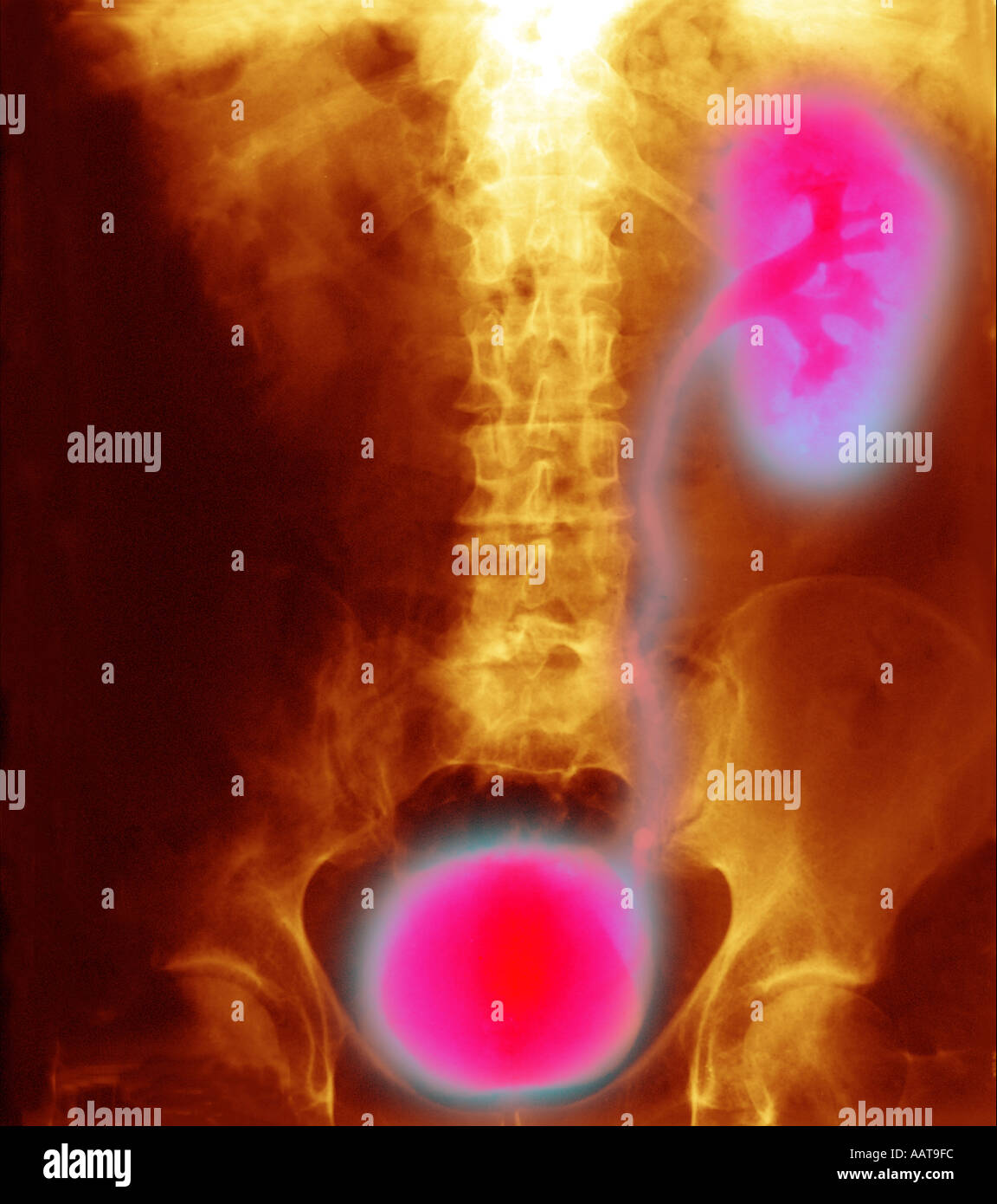 abdomen xray showing bladder and kidney Stock Photo Alamy
