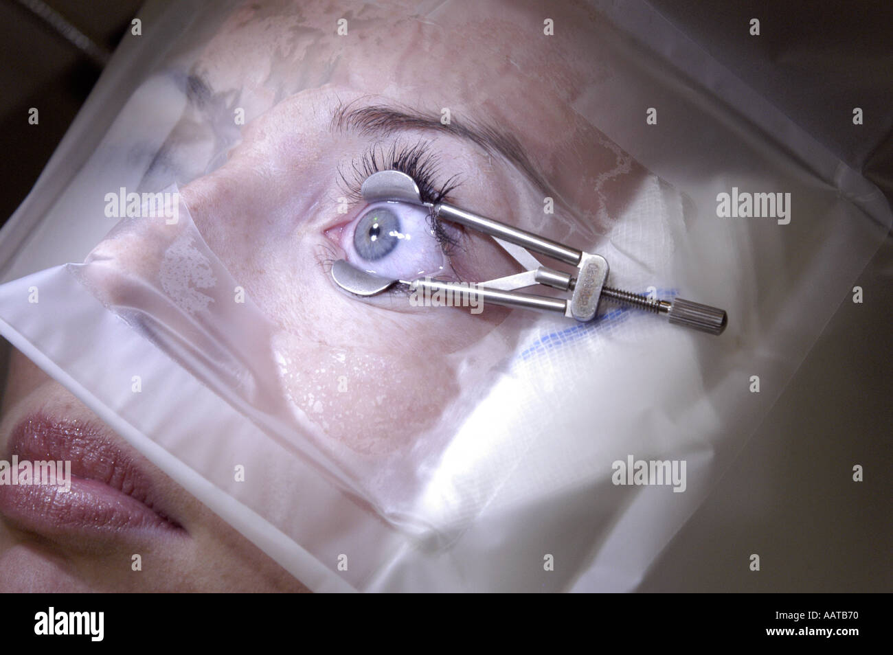 A PATIENTS EYE IS CLAMPED PRIOR TO LASER EYE SURGERY MANDATORY CREDIT
