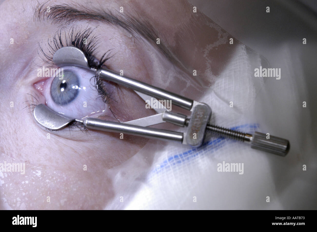 A PATIENTS EYE IS CLAMPED PRIOR TO LASER EYE SURGERY MANDATORY CREDIT