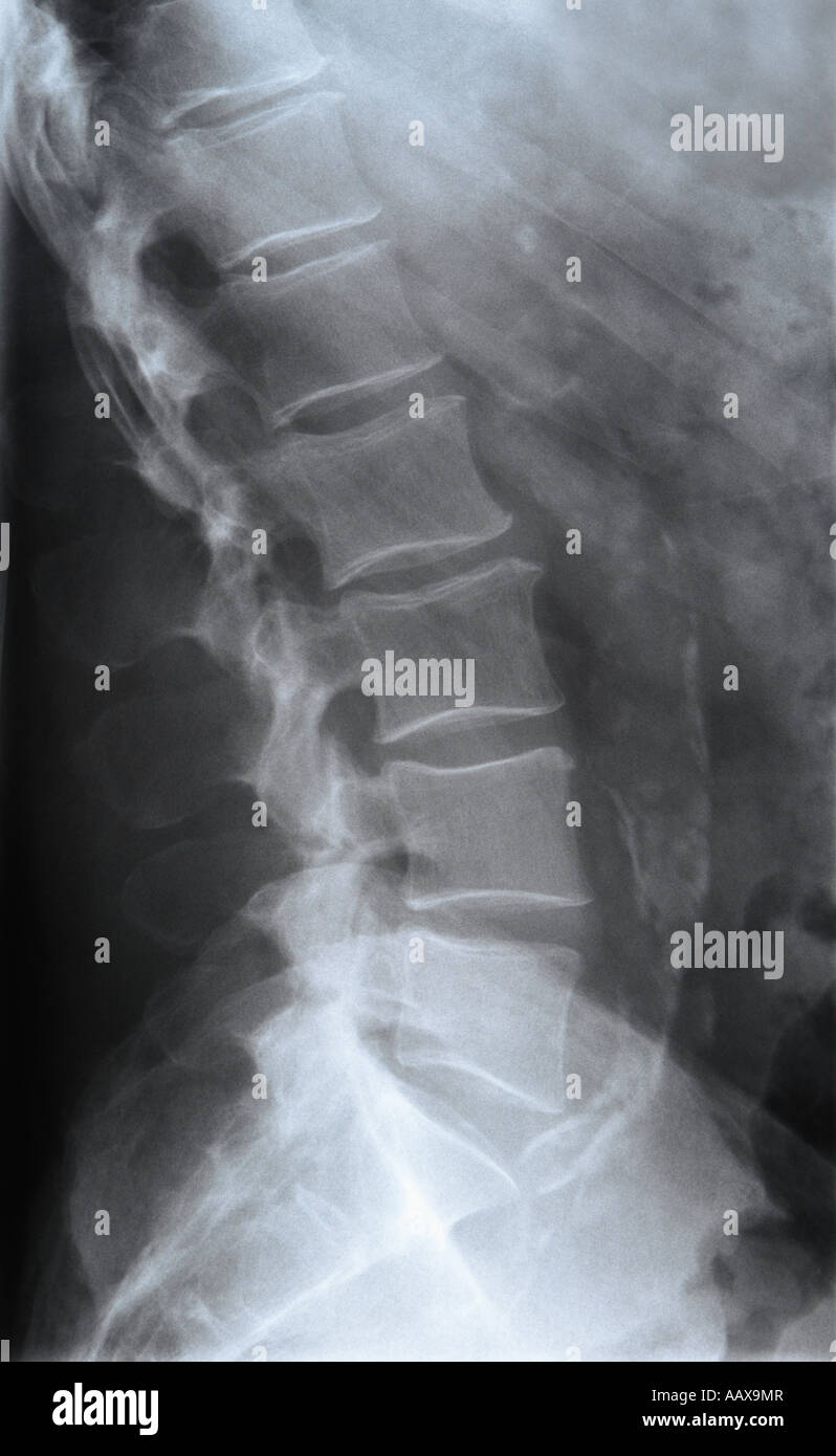 Human Lumbar Spine x-Ray side view Stock Photo - Alamy