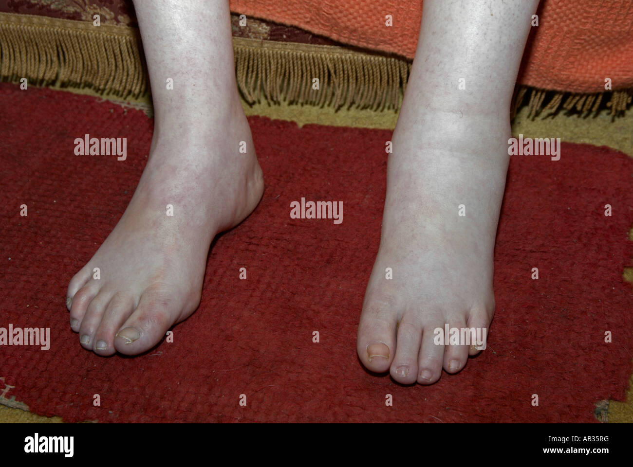 Swollen left ankle with normal right ankle due to a high grade soft tissue on woman in