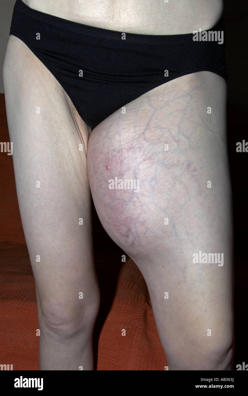 Swollen inner top thigh muscle