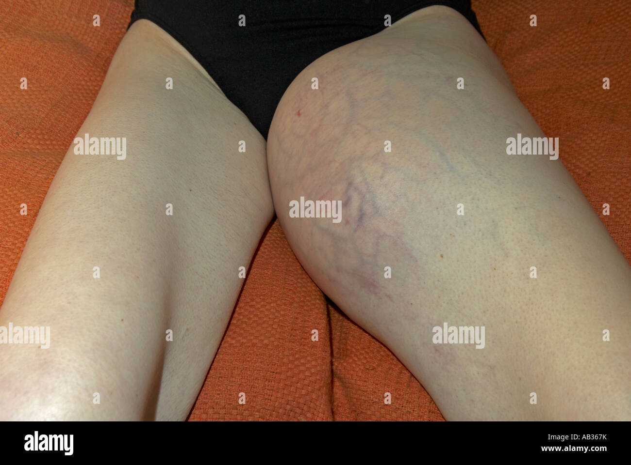 High Grade Soft Tissue Sarcoma on the left inner thigh in her 30s / 40s  Stock Photo - Alamy
