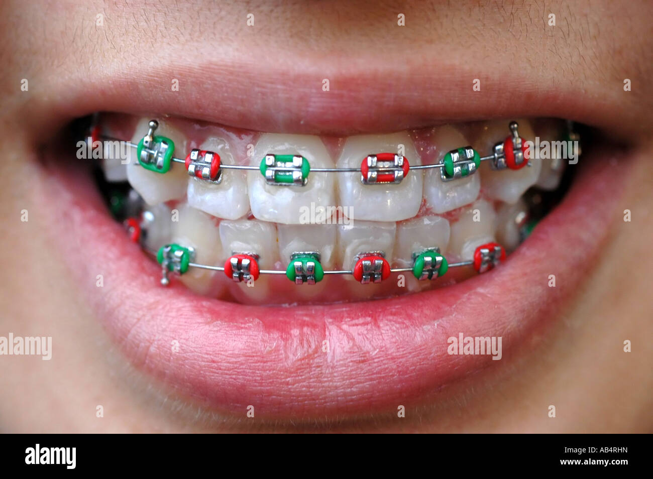 Colourful braces hi-res stock photography and images - Alamy