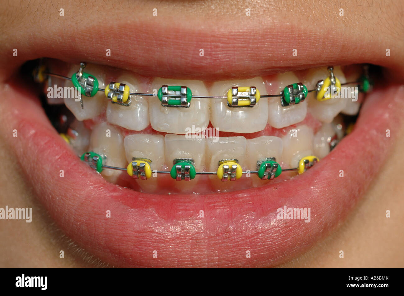 Smile appearance braces teeth hi-res stock photography and images - Alamy