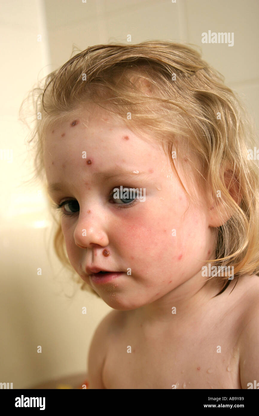 Toddler with Chicken Pox looking unhappy Childhood ailments Stock Photo