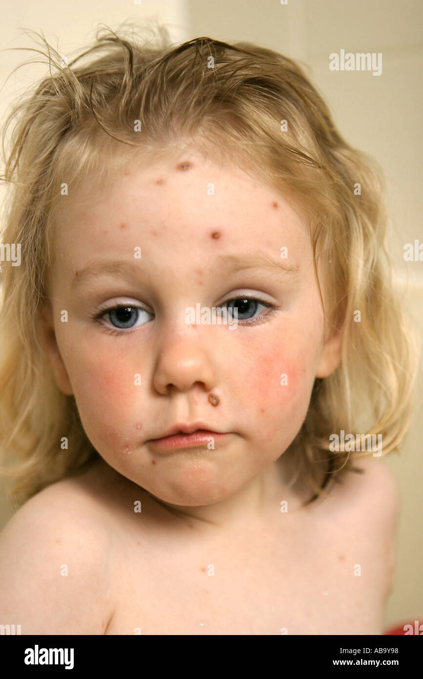 Toddler with Chicken Pox with a sad expression Childhood ailments Stock Photo