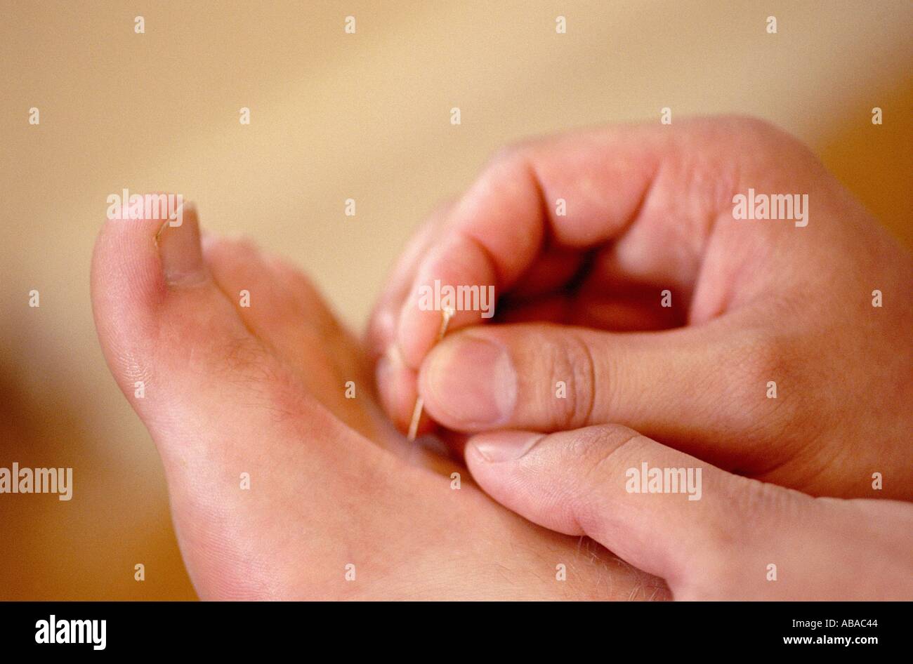 Hand care acupuncture hi-res stock photography and images - Alamy
